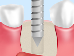 抜歯即時インプラント